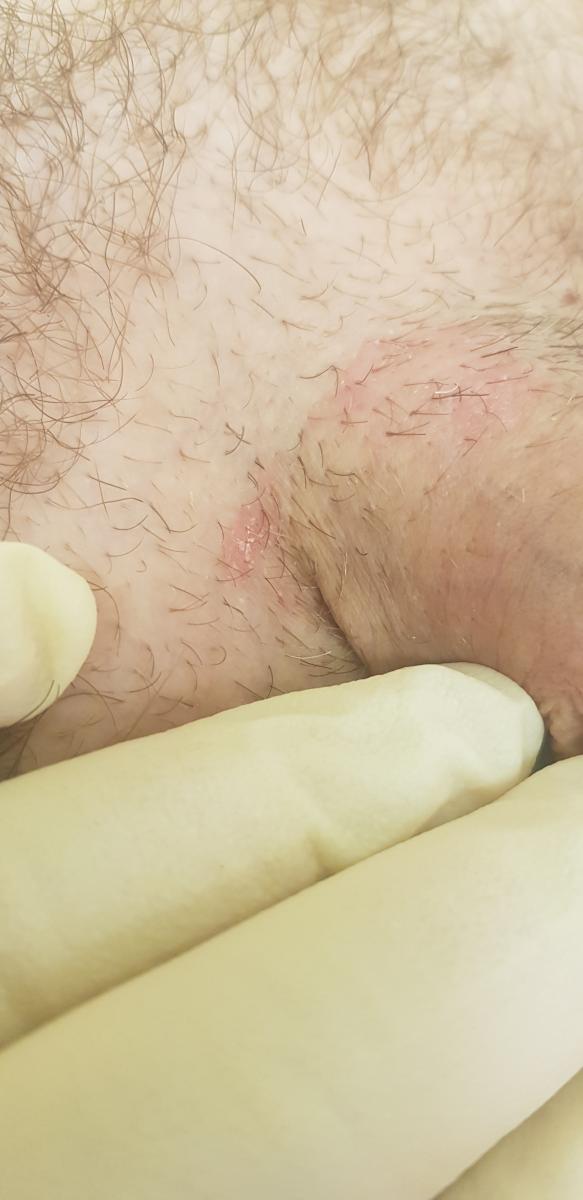  шелушение основания члена