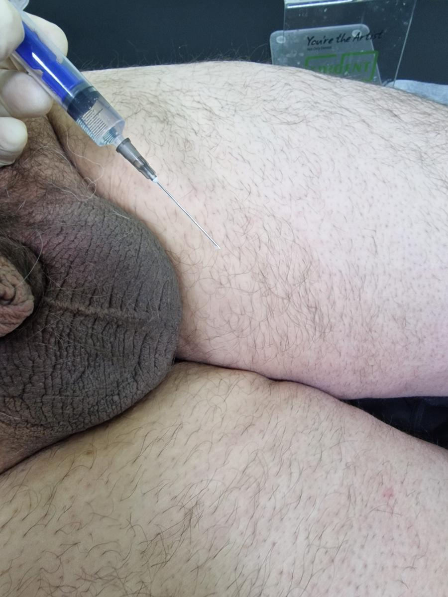 лимфотропная терапия лимфо