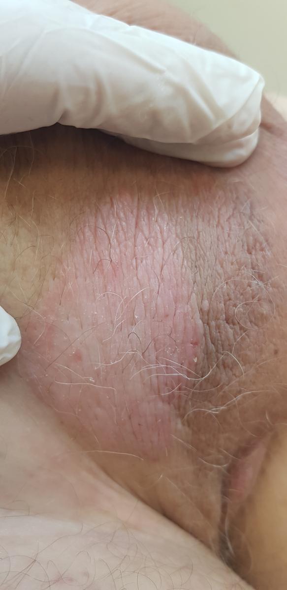 Хронический зуд в паховых складках – лишай Видаля. Хронический зуд