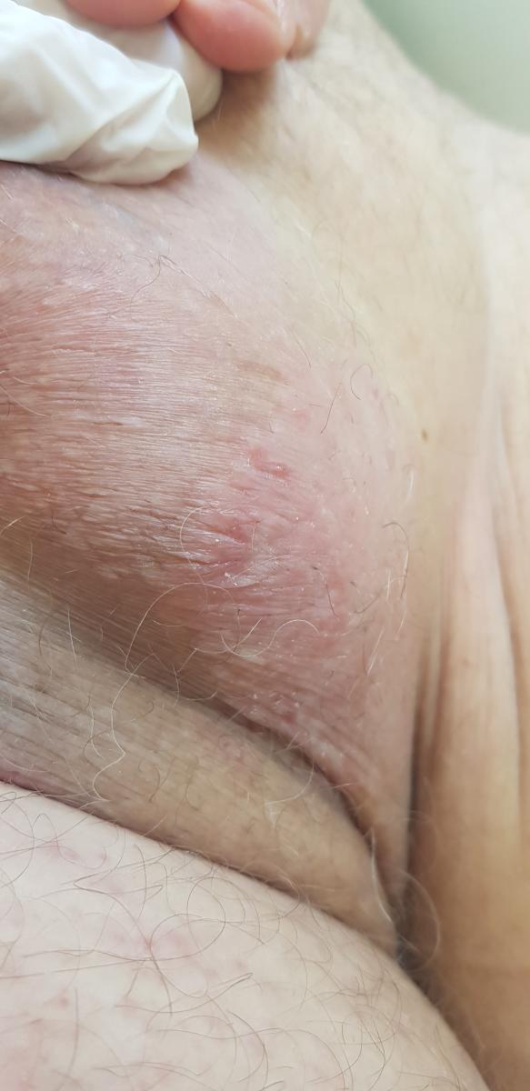 Хронический зуд в паховых складках лишай Видаля.