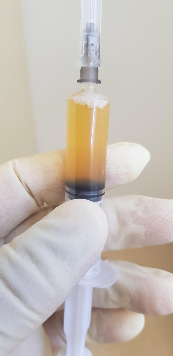 плазмолифтинг плазма