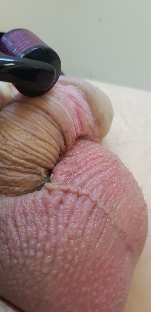 дермароллер