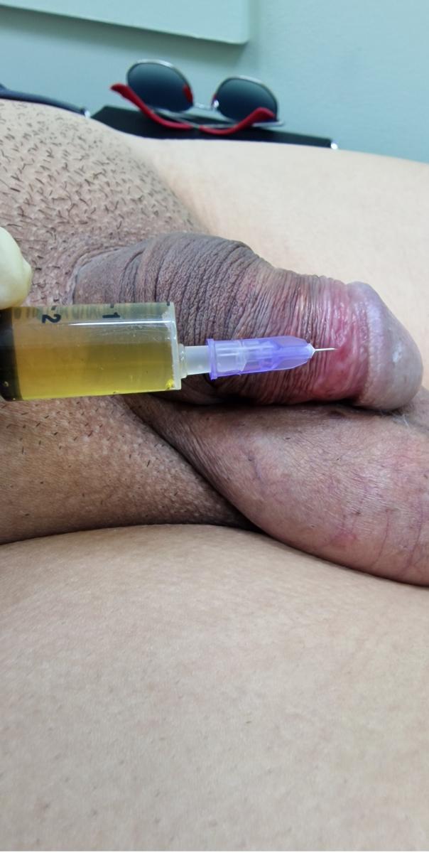 плазмолифтинг