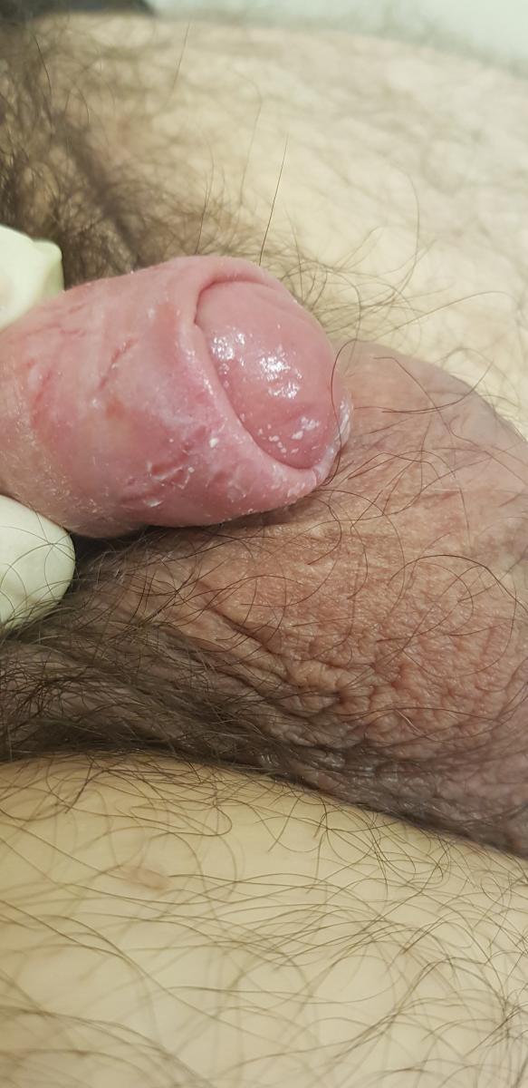 трещины до лечения