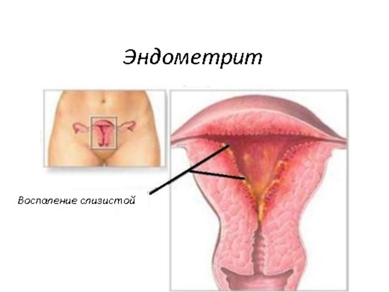 эндометрит – осложнение гонореи у женщин