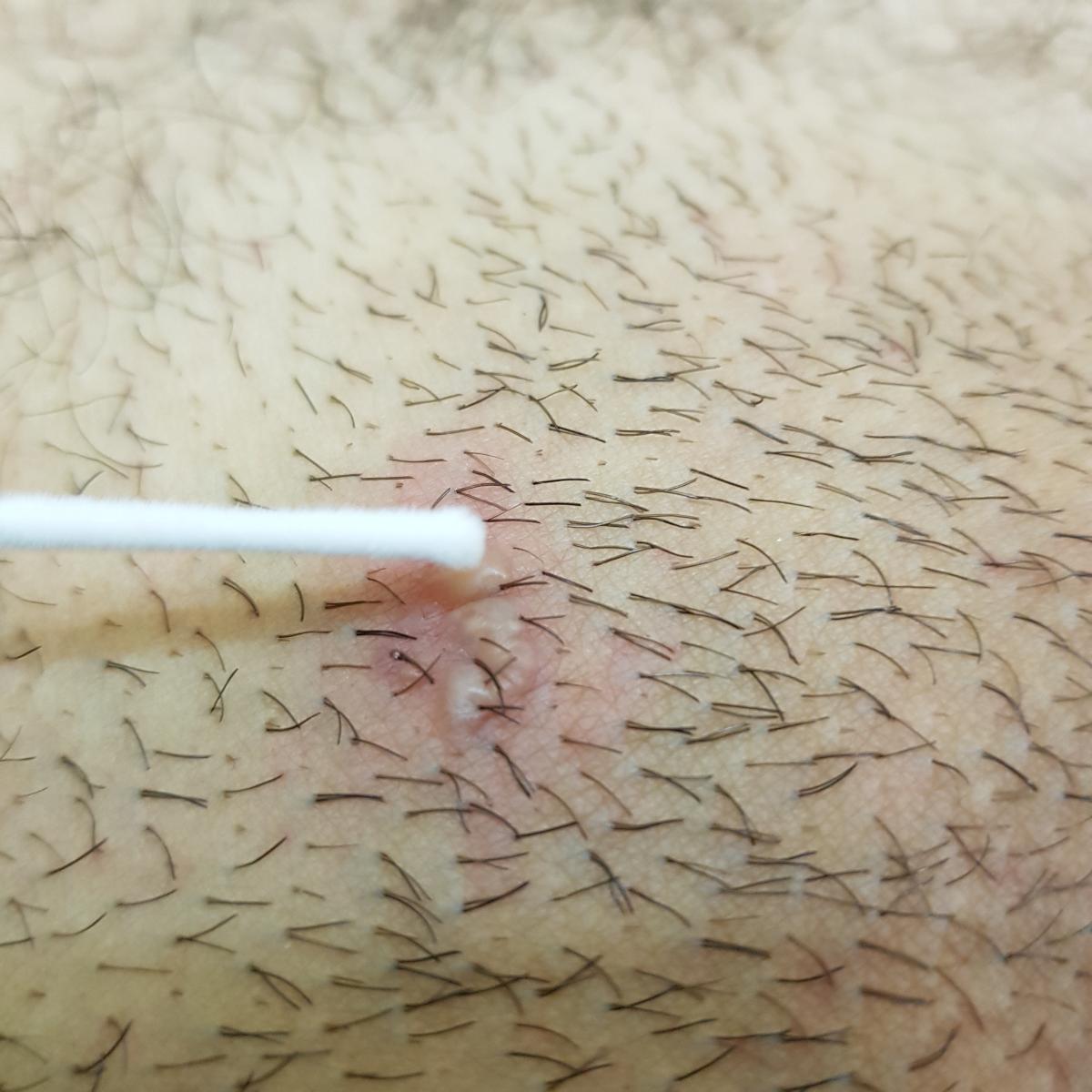 забор мазка взятие мазка на инфекцию