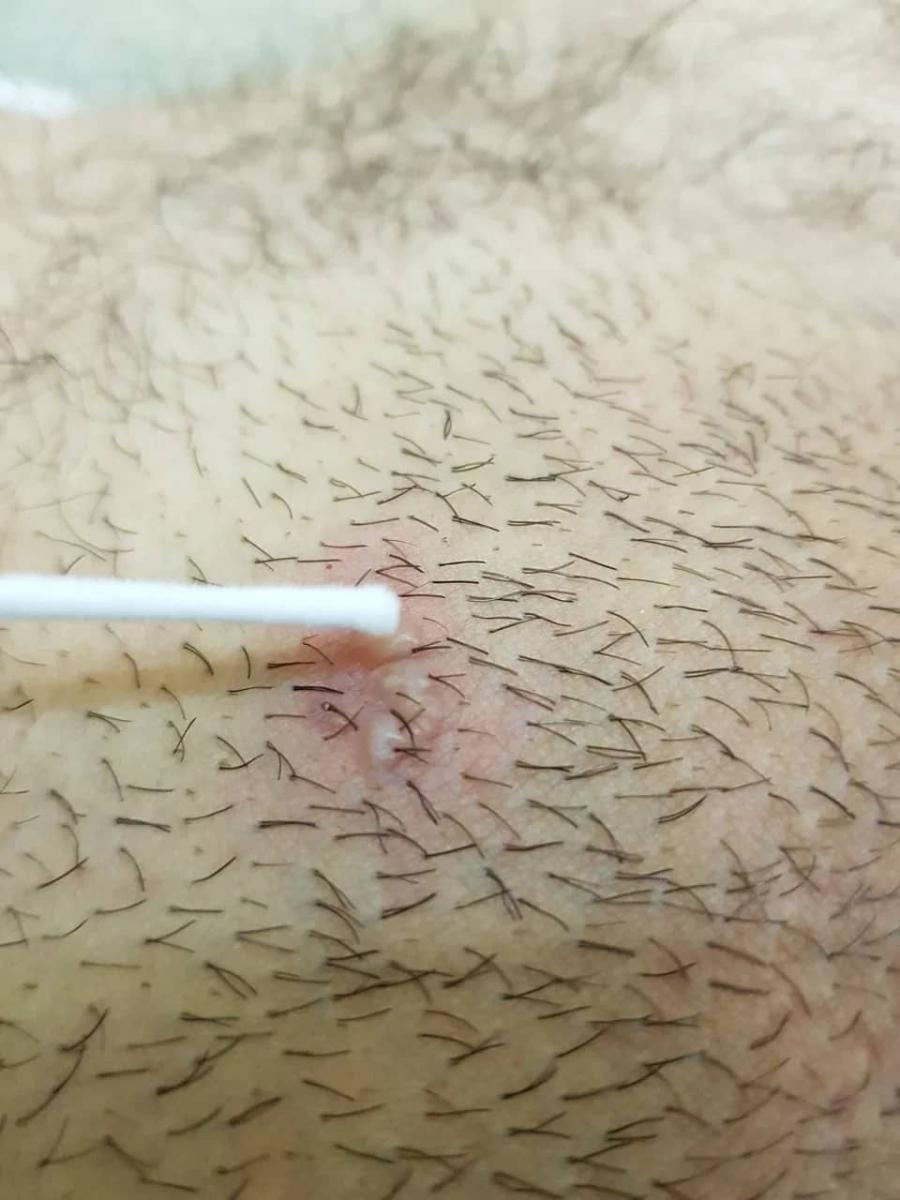 Забор содержимого