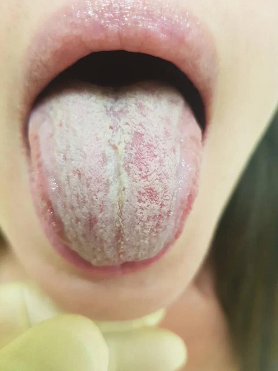 жжение на языке жжение на языке