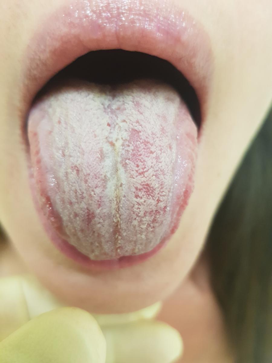 Белый язык кандидоз