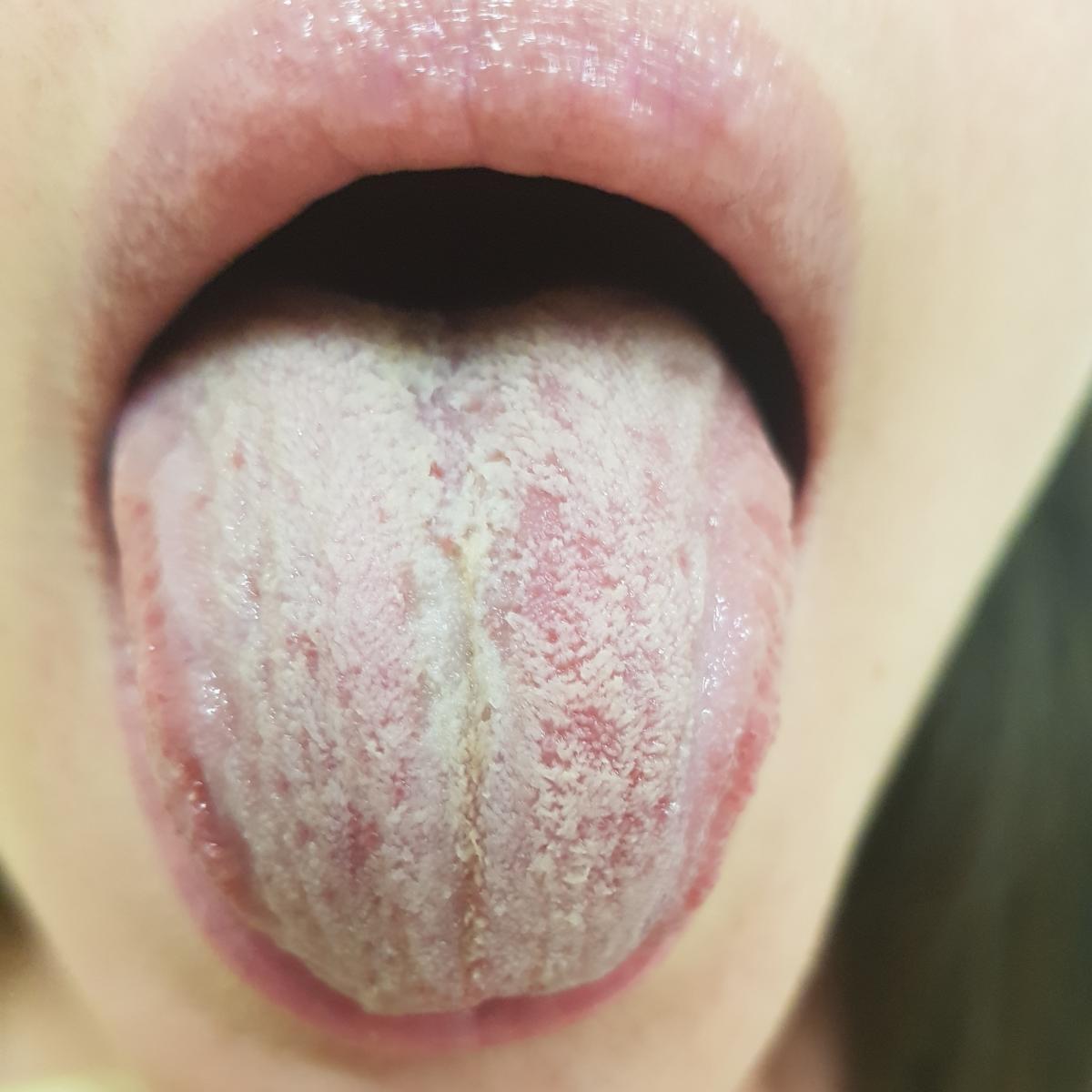 Кандидоз на языке Кандидоз