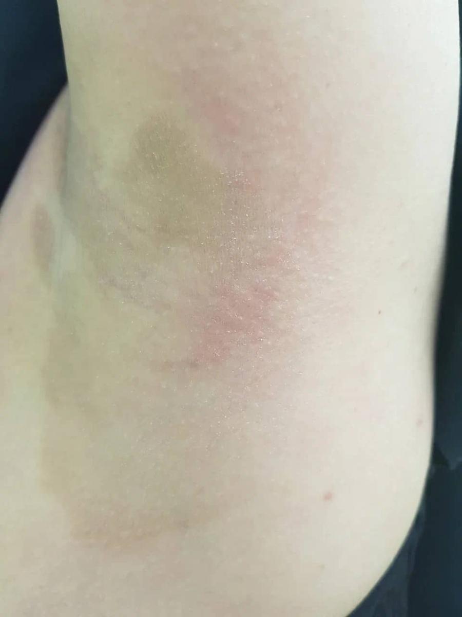 Эритразма у женщин Эритразма подмышкой