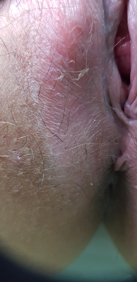 зуд влагалища