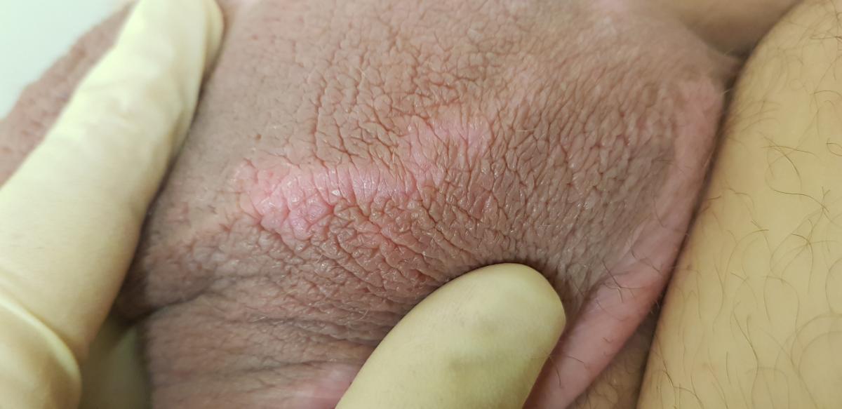 зуд и белые пятна на мошонке зуд шва и витилиго