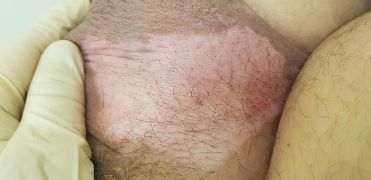 белые пятна на мошонке витилиго