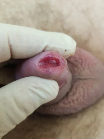 фото после удаления в уретре при вирусе папилломы человека