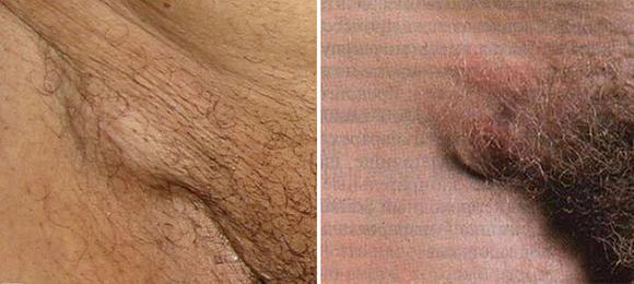 Увеличенные паховые лимфоузлы при половом герпесе болезненны при прощупывании.