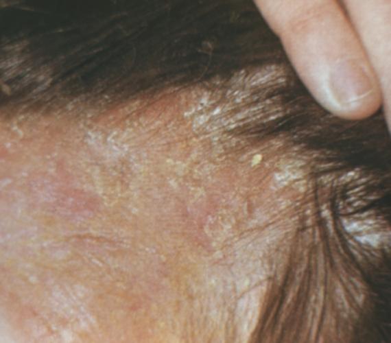 Симптомы уплотненно-нагноительного грибка кожи волосистой части головы