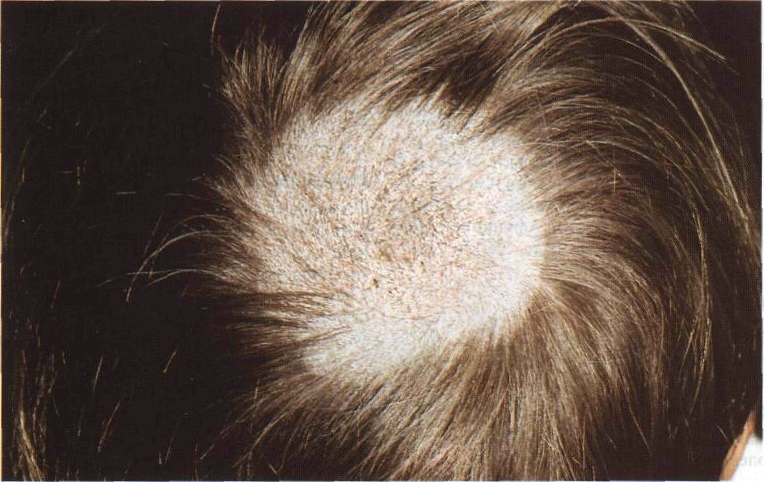 Проявления грибка кожи головы при поражении грибками животных (микроспория)