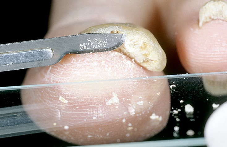 Соскоб на грибок ногтя