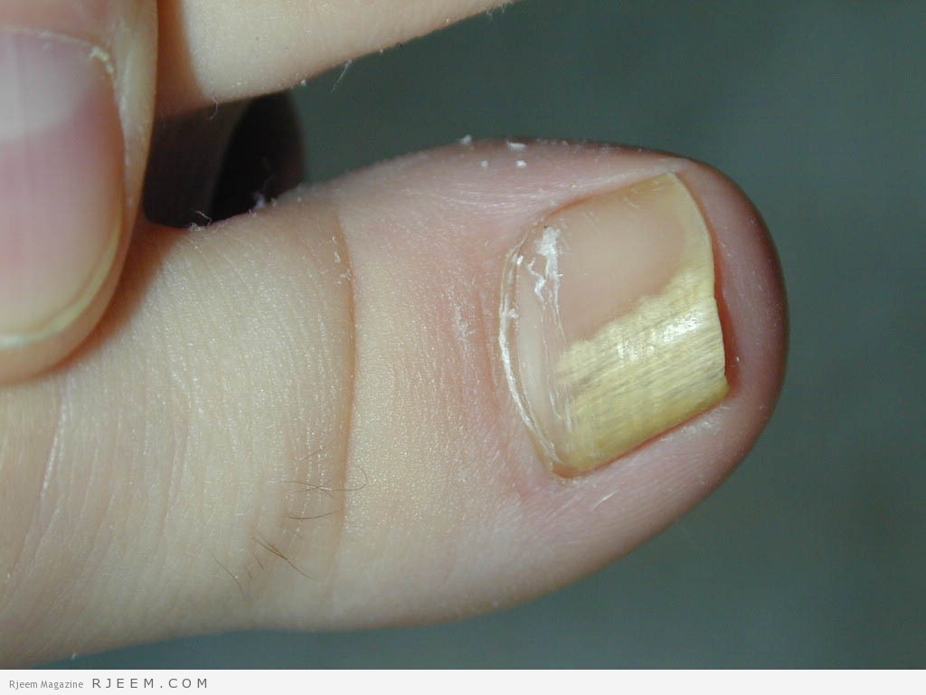 наружная форма грибка ногтей