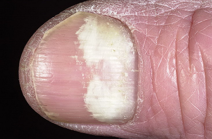внутренняя форма грибка ногтей