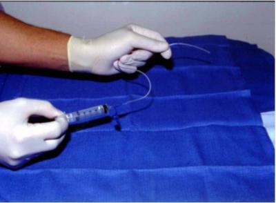 обработка слизистой уретры при лечении хламидиоза