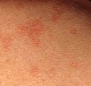 Симптомы отрубевидного лишая – темные пятна на коже