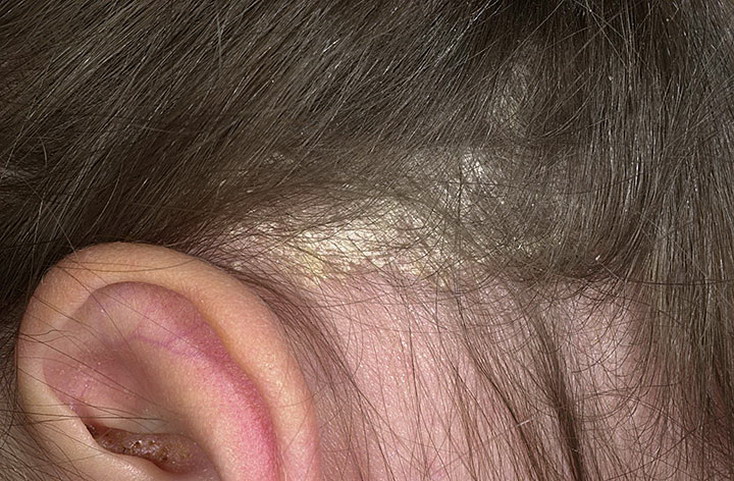 Себорейный дерматит на волосистой части головы