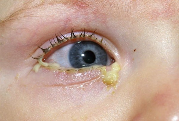 Гонококки могут попадать на слизистую оболочку глаз, вызывая бленнорею (гнойное воспаление глаз).