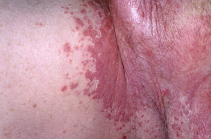 Сыпь на теле | причины, симптомы, виды высыпаний на коже, лечение