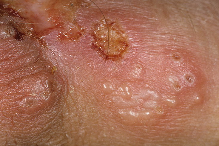 Пузырьки при герпесе половых органов на слизистой и коже могут превращаться в язвы и эрозии. 