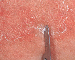  анализы соскоба кожи при покраснении в паху у мужчин