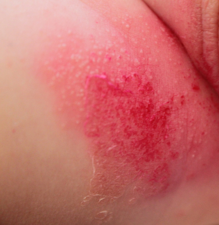  Аллергия кожи в паху