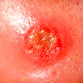 сифилитическая язва на коже