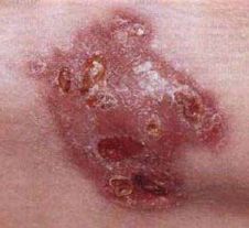 гумма на коже при третичном сифилисе