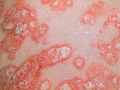  Инфекционные кожные заболевания, которые лечит дерматовенеролог