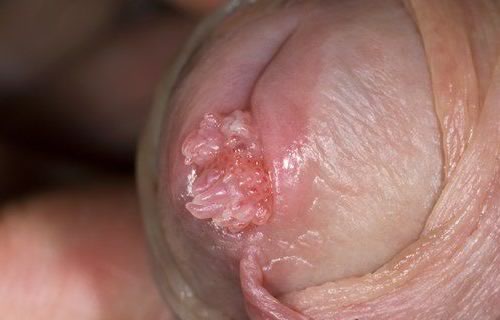  рези при мочеиспускании при генитальных бородавках в уретре 