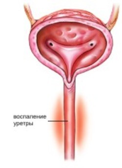 гонорейный уретрит (воспаление мочеиспускательного канала)
