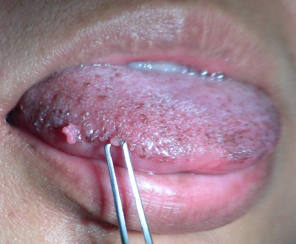  вирус папилломы человека во рту
