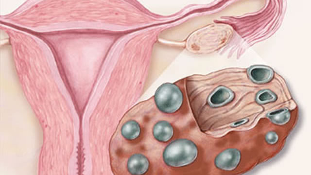 Увеличение выработки тестостерона возможно при нарушении функции яичников, поликистозе