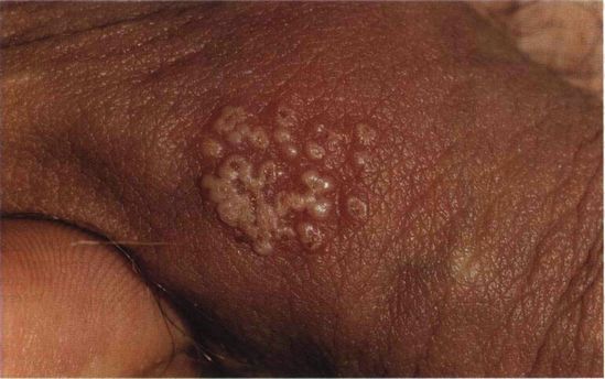  Вирус генитального герпеса. Проявляется через 2-10 дней после заражения эрозивно-язвенными образованиями 