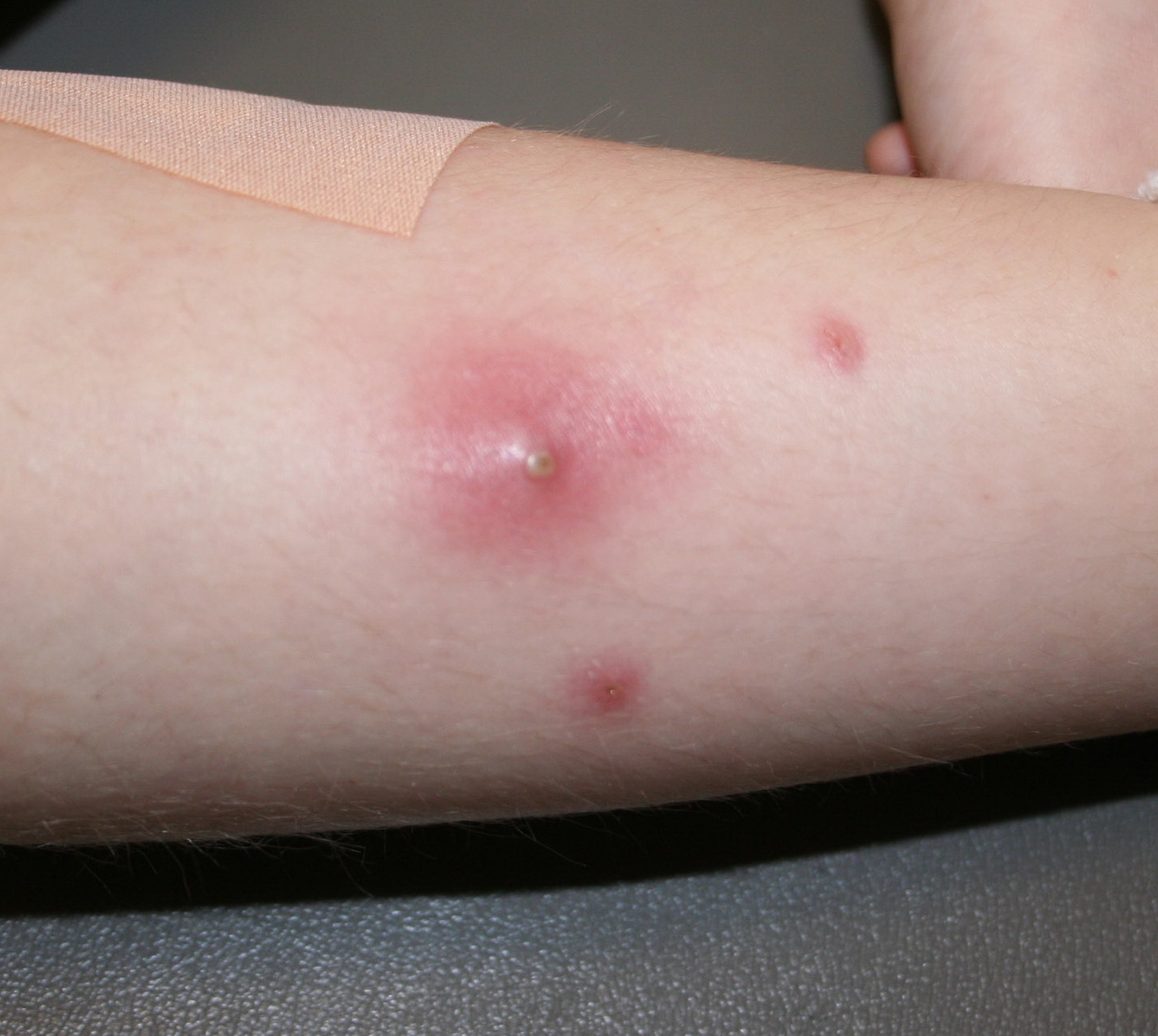  воспаление паховых лимфоузлов при инфекциях кожи