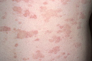 красные пятна на коже при вторичном сифилисе
