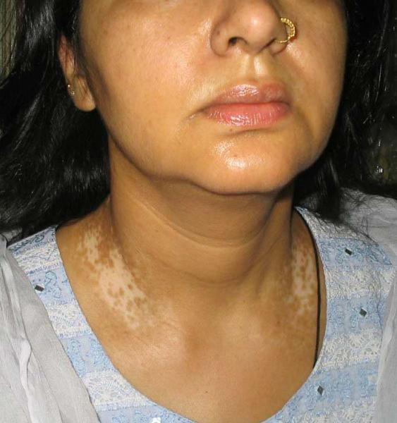 сифилитическая лейкодерма на шее у женщины