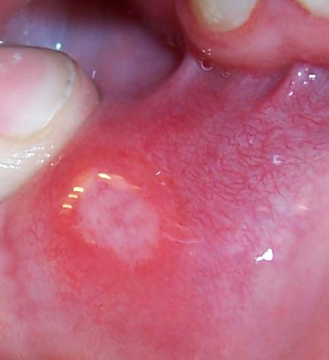 сифилитический шанкр во рту