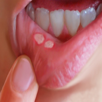 твердый шанкр во рту при первичном сифилисе