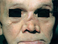 разрушение носа при третичном сифилисе