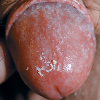 Красные пятна на головке пениса – причины, симптомы и лечение | Медцентр Лекарь в Красногорске