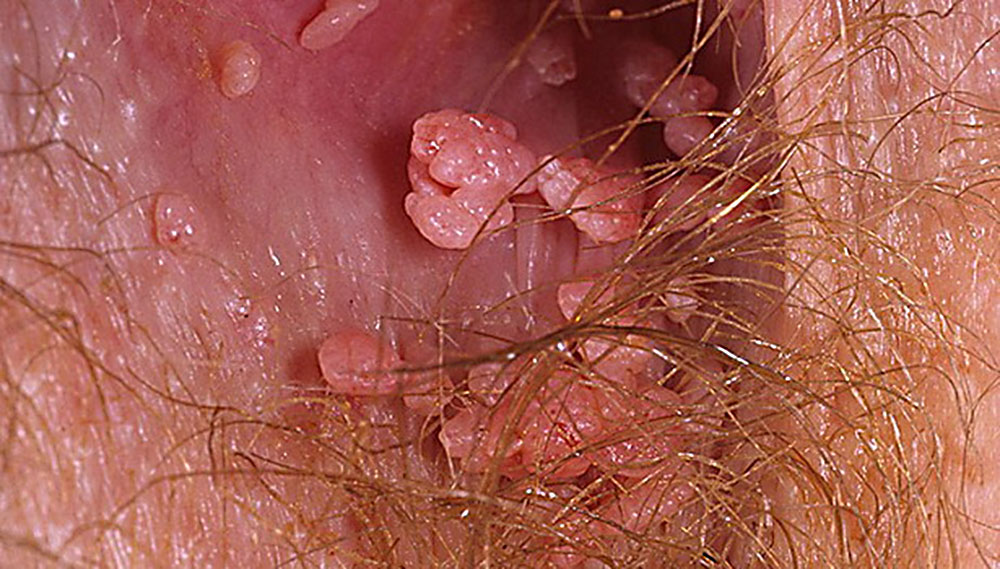 остроконечные кондиломы в области ануса при вирусе остроконечной кондиломы