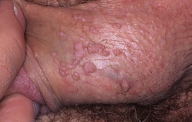 Остроконечные кондиломы: кожные проявления образуются на коже и слизистых оболочках половых органов.